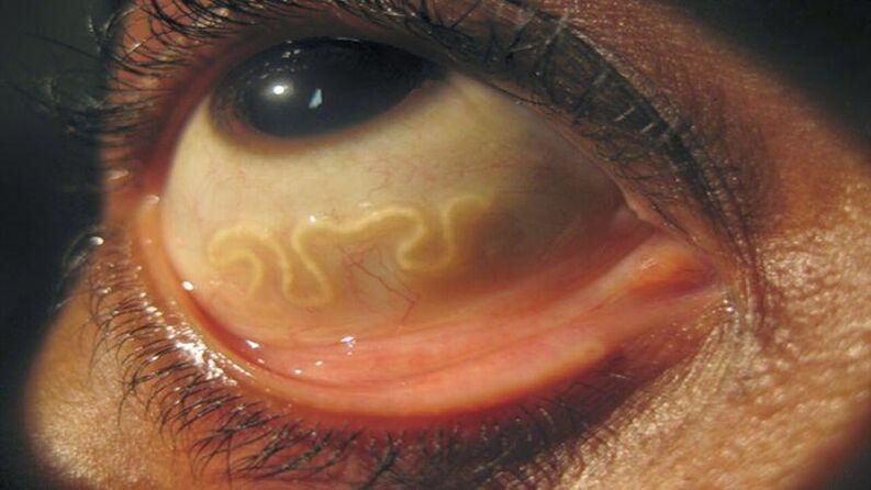 Parasita no globo ocular humano